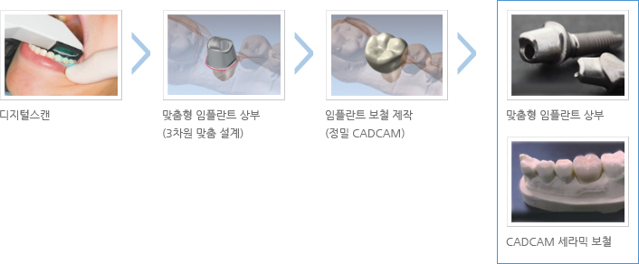 디지털스캔 > 맞춤형 임플란트 상부(3차원 맞춤 설계) > 임플란트 보철 제작(정밀 CADCAM) > 맞춤형 임플란트 상부, CADCAM 세라믹 보철