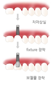 치아상실 > fixture 장착 > 보철물 장착