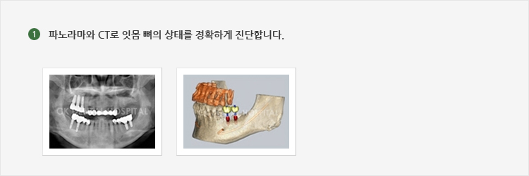 파노라마와 CT로 잇몸 뼈의 상태를 정확하게 진단합니다.