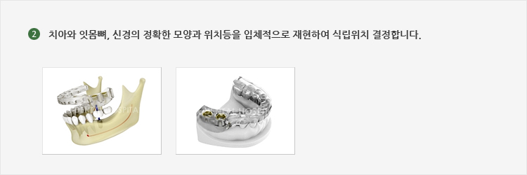 치아와 잇몸뼈, 신경의 정확한 모양과 위치등을 입체적으로 재현하여 식립위치 결정합니다.