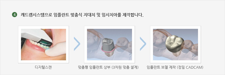 캐드캠시스템으로 임플란트 맞춤식 지대치 및 임시치아를 제작합니다.