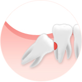 사랑니에 충치가 생기거나 사랑니와 어금니 사이 충치를 유발합니다.