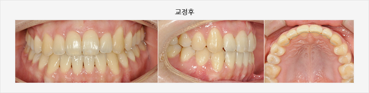 교정후