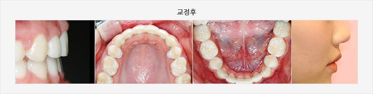 교정후