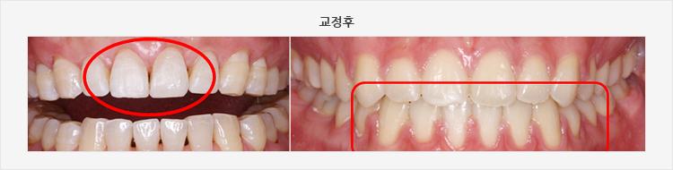 교정후